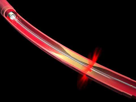 Fractional Flow Reserve