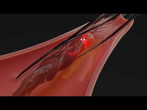Laser hemorrhoidoplasty