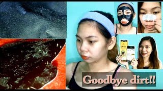 HOW I GOT RID OF MY WHITE AND BLACKHEADS | Willyn D.