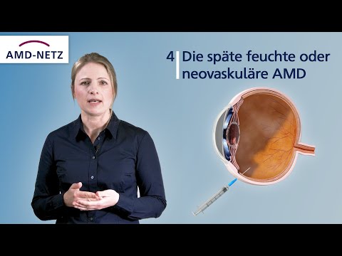 4.  Die späte feuchte oder neovaskuläre AMD
