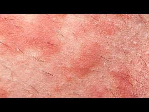 Hogyan kezeljük a bőrt belülről pikkelysömörrel