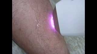Diode laser - Lars Medical