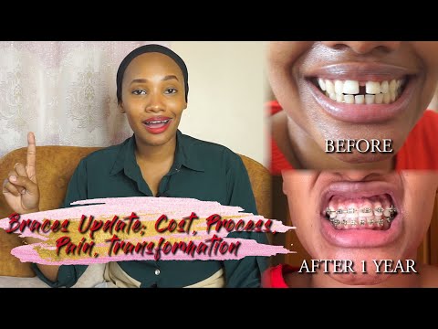 1 Year Braces Update | Everything you need to know, Cost, Process, Pain | Braces In Kenya 2021
