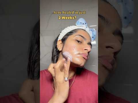 How to use tretinoin for acne? #tretinoincream #pharmacy #acneproneskin #acnejourney