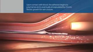 Sellado de troncos safenos con pegamentos biológicos - IVEI Clínica Vascular Marbella