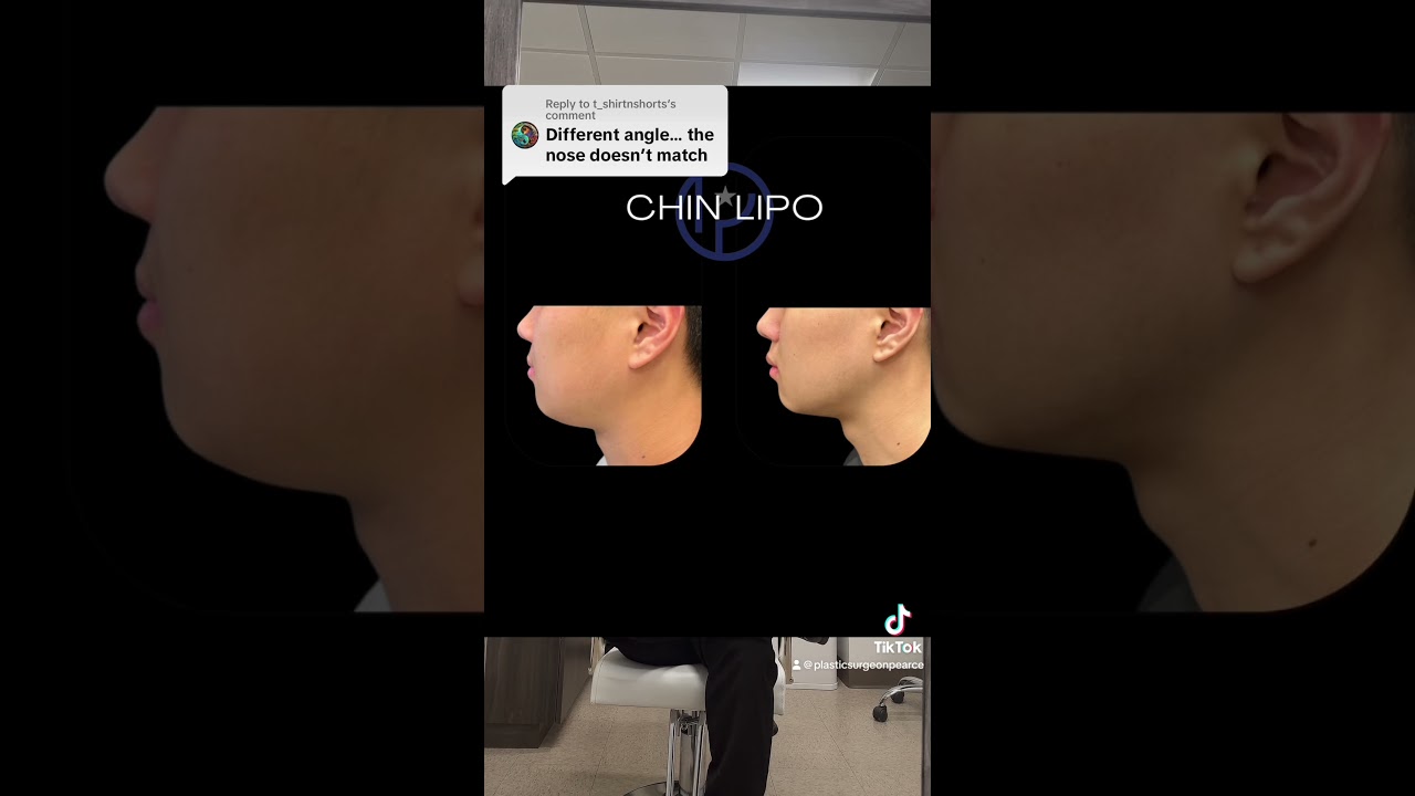 They don’t believe its the same guy || Austin Chin Lipo