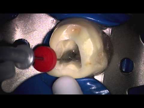 Introducing PROTAPER NEXT