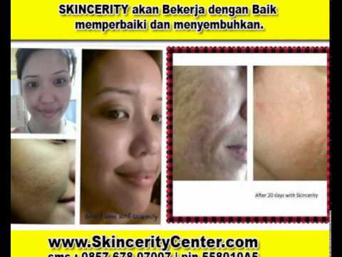 +62.857.678.07007 (IM3), Skincerity Untuk Jerawat, Skincerity Untuk Parut Jerawat