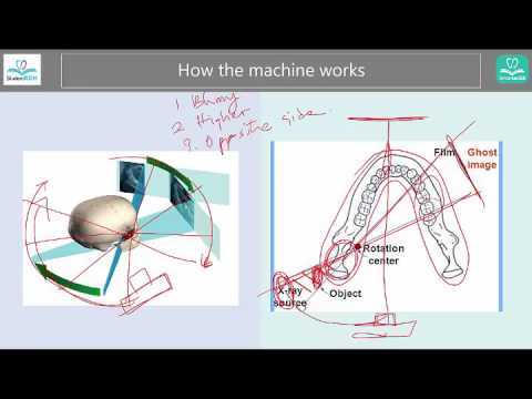 Panoramic radiographs - Ghost image, charateristics [SIMPLE]