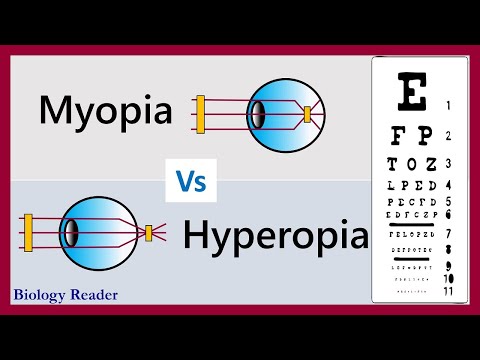 Difference Between Myopia and Hypermetropia (with Comparison Chart) - Biology Reader