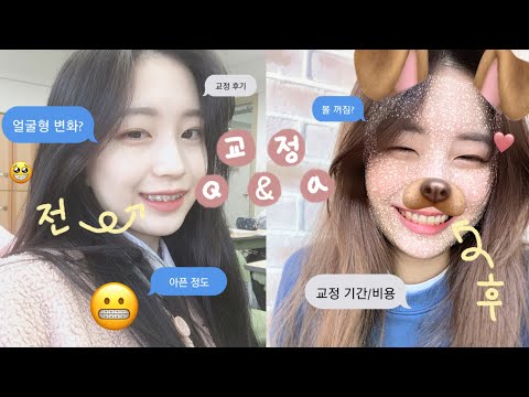 치아 교정 후기 및 Q&A / 치아 발치?! / 교정 기간 / 못 먹는 음식 / 주의할 점 ㅣ [ 해아/hae_a ]