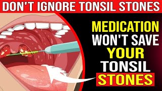 What CAUSES Tonsil Stones and How to Prevent Them – Doctors Don’t Tell You THIS!
