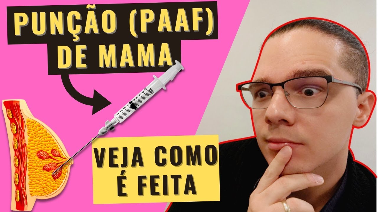 PUNÇÃO (PAAF) DE MAMA GUIADA POR ULTRASSOM: Veja COMO É FEITA e a diferença para a CORE BIOPSY !