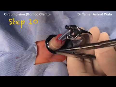 Circumcision Gomco Clamp Step by step Demonstration Dr. Tamer Ashraf Wafa