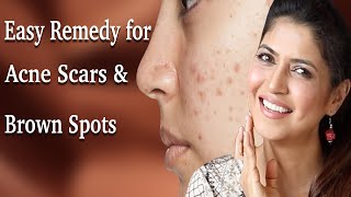 Get Rid of Acne Scars, Dark Spots with 2 Simple Ingredients  - Ghazal Siddique