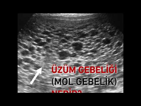 Mol (üzüm) gebeliği)