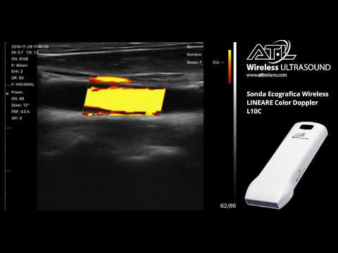 ATL Sonda ecografica wireless LINEARE