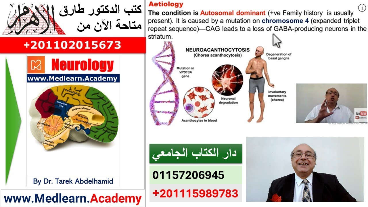 Huntington Chorea #usmle #internal_medicine #cme #medicaleducation #ecg   #محاضرات_باطنة #medical