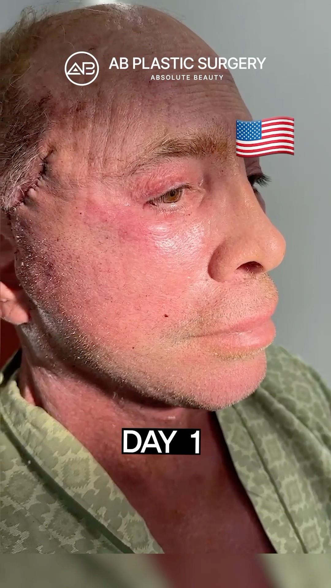 Day After My Facelift in Korea