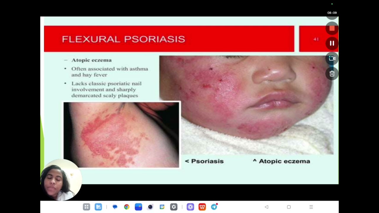 Psoriasis, Lichen planus Etiology, Clinical features, Diagnosis and Treatment