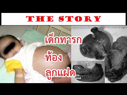 ในการรักษาโรคสะเก็ดเงินส้นเท้าแตก วิธีการรับรู้โดยการวิเคราะห์โรคสะเก็ดเงิน