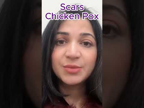 , title : 'Chicken Pox Scars Treatment l Chicken Pox Face Care l Chicken Pox Skincare'