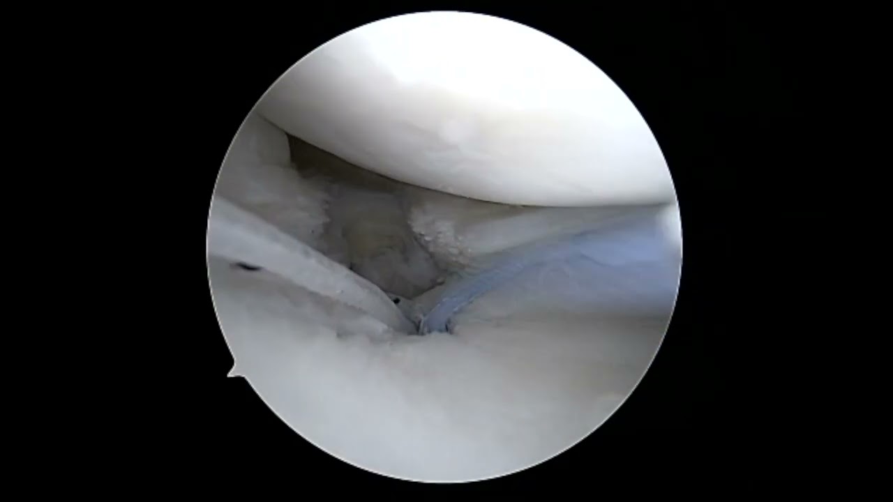 Meniscal Root Repair with the new Arthrex Sutureloc