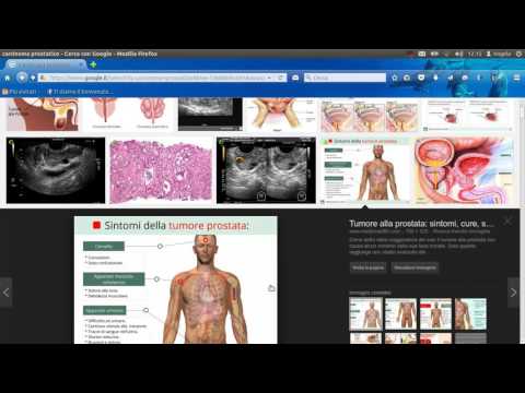 Trasmessa se BPH Come porre fine le foto massaggio prostatico