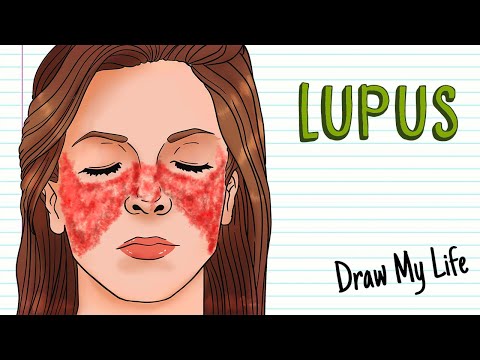 WHAT IS LUPUS? | Draw My Life