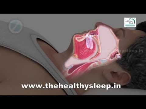 Obstructive Sleep Apnea Treatment in Kannur | Snoring Solution in Kerala | Snoring Cure in India
