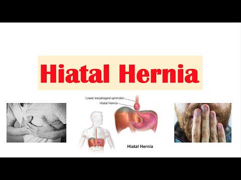 Hiatal (Hiatus) Hernia | Risk Factors, Types, Signs & Symptoms, Diagnosis, Treatment