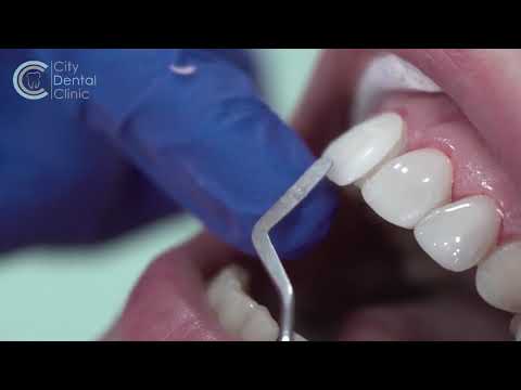 Dental Veneers Behandlungsablauf