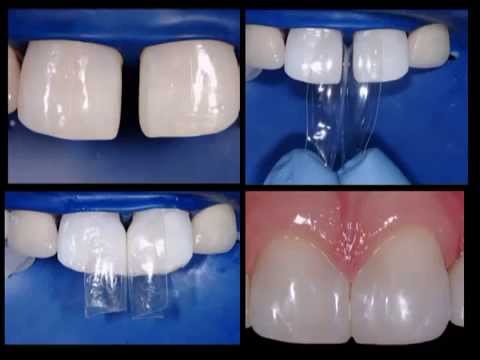 Diastema Closure. David Clark