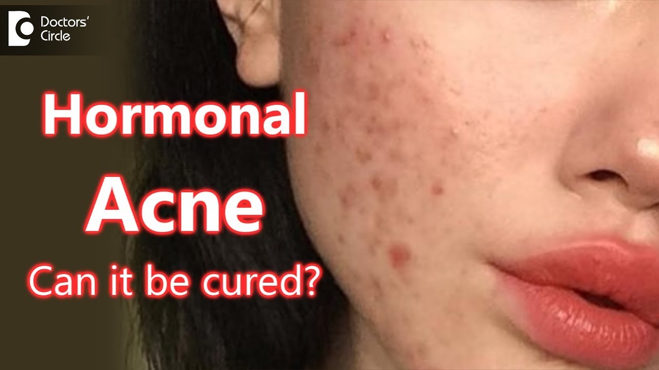 Can Hormonal Acne be cured - Dr. Rasya Dixit