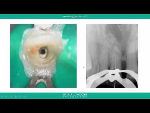 Cbct as an aid to locate calcified canals