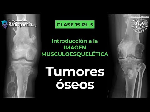 15.5 - Tumores óseos: Semiología radiológica básica y tumores mas comunes
