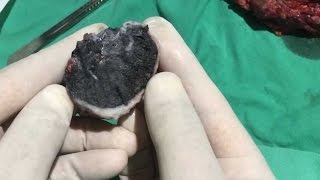 Dissected Black Lung, Lung Disease and Coal Power