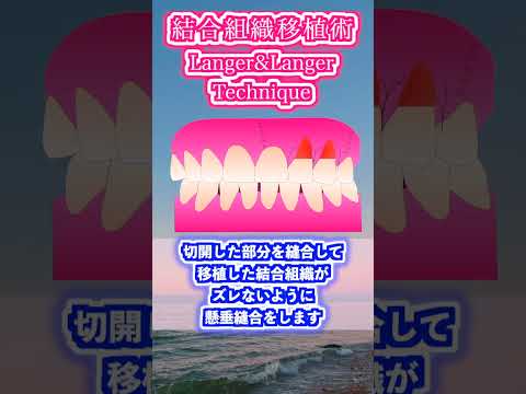 生命歯学科 歯周外科手術　結合組織移植術（Langer&Langer technique)について解説します！　#shorts  #歯周外科　＃歯周病　＃歯を抜かない　＃歯を残す  #dentist #歯肉移植