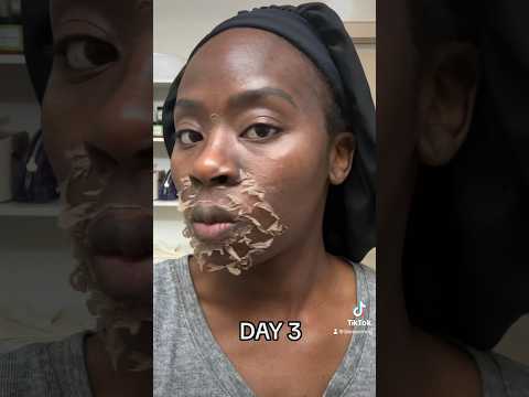 Chemical Peel Journey for black skin #chemicalpeel #skincare