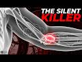 The Silent Warning Signs Of Blood Clots