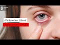 Meibomian Gland Dysfunction (MGD) & How it is corrected? - Dr. Sunita Rana Agarwal | Doctors' Circle