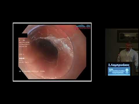 Λαμπρινάκος Στέλιος - Αντιμετώπιση διάχυτου οισοφαγικού σπασμού οισαφάγου με την μέθοδο της ενδοσκοπικής μυοτομής (POEM)