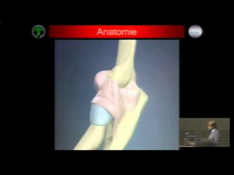 Chirurgie Knieersatz nach Bedarf Schmerzen in Osteochondrose Beinbehandlung
