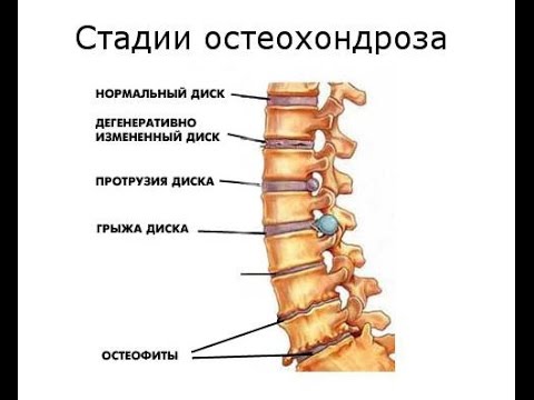При остеохондрозе после массажа все болит Таблетки от боли в суставах и мышцах спины