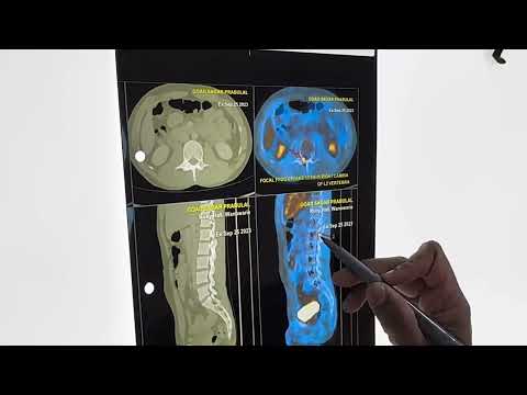 Osteoid osteoma tumour spine operated using Robotic technology