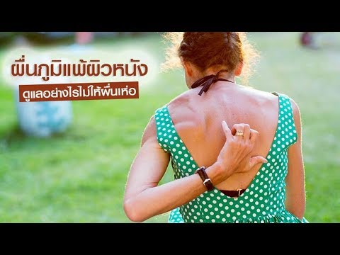 โลชั่น belosalik โรคสะเก็ดเงินบนหัว รักษากลากในหู