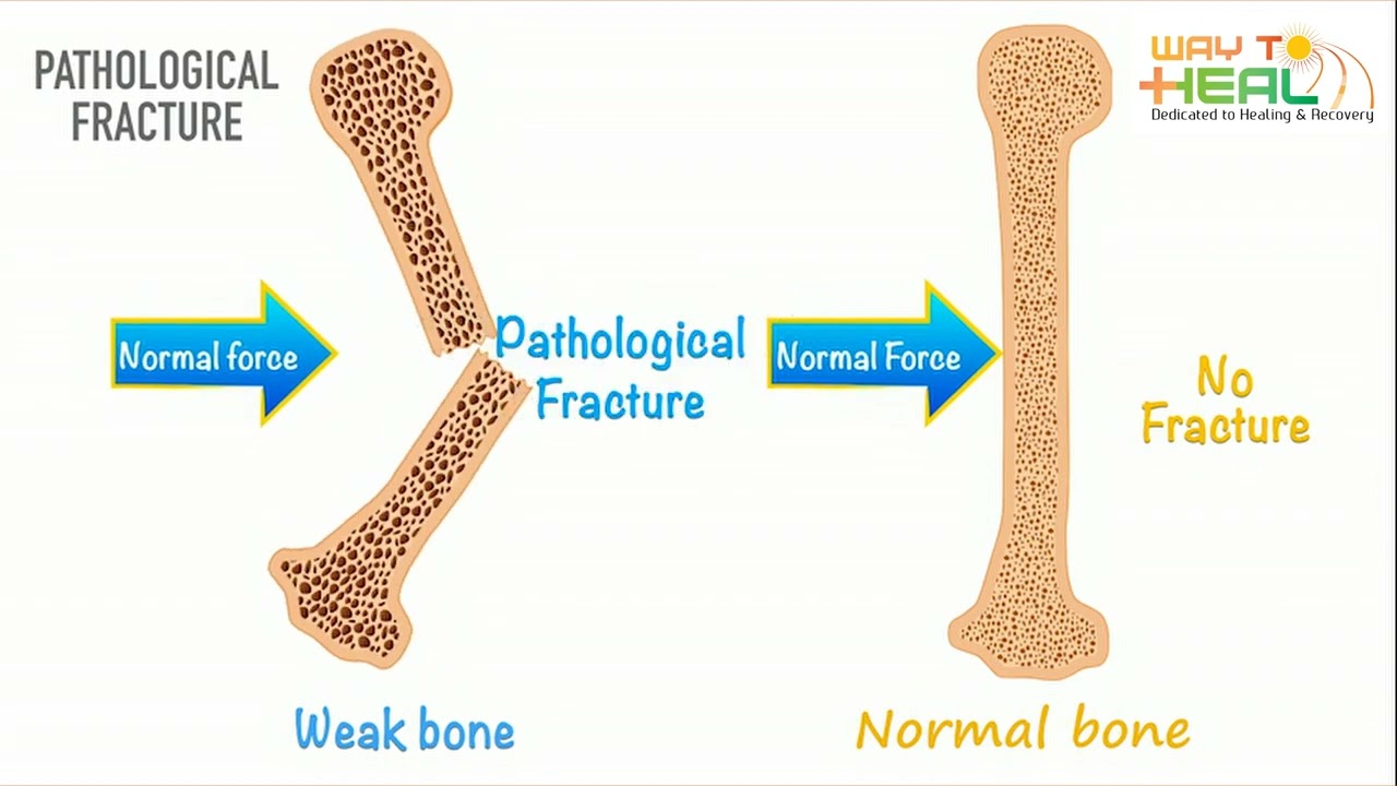 Symptoms of Bone Sarcoma (Bone Cancer)