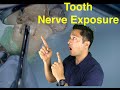 Deep Tooth Cavity!! - Healed Tooth without a Root Canal!