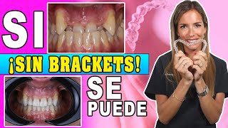 🤷🏼‍♀️¿Quieres 𝗘𝗡𝗗𝗘𝗥𝗘𝗭𝗔𝗥 los dientes 𝗦𝗜𝗡 𝗕𝗥𝗔𝗖𝗞𝗘𝗧𝗦 👉Como Funcionan los 𝗔𝗟𝗜𝗡𝗘𝗔𝗗𝗢𝗥𝗘𝗦 𝗜𝗡𝗩𝗜𝗦𝗜𝗕𝗟𝗘𝗦