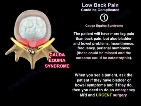 Komplizierte Schmerzen im unteren Rückenbereich